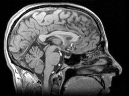 Huntingtin protein molecules with too many glutamines can’t assemble properly so can form toxic clumps which have been shown to build up in patient's brains over time. However these clumps are not visible in most types of brain scans like MRIs.